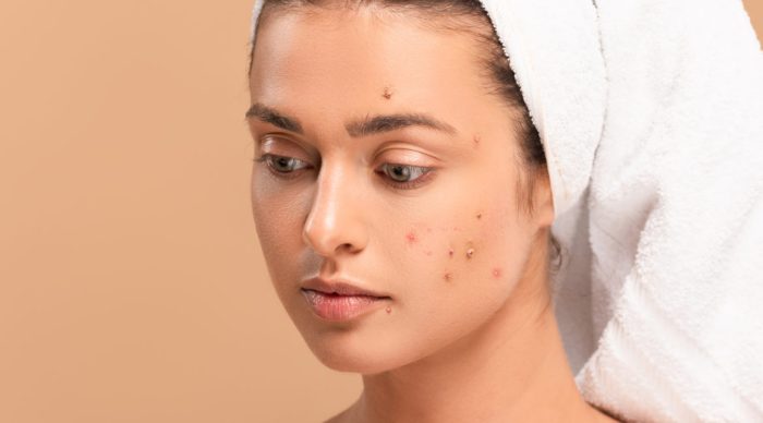Acne Treatments: Tackling Skin Concerns Worldwide