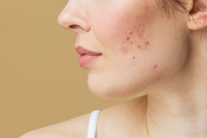 Acne: tipos e cuidados - Dermatologista Dra. Marcela Uehara Acne Treatments: Tackling Skin Concerns Worldwide